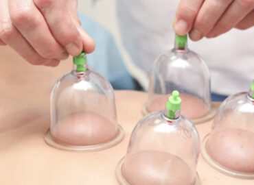 Cupping Therapy